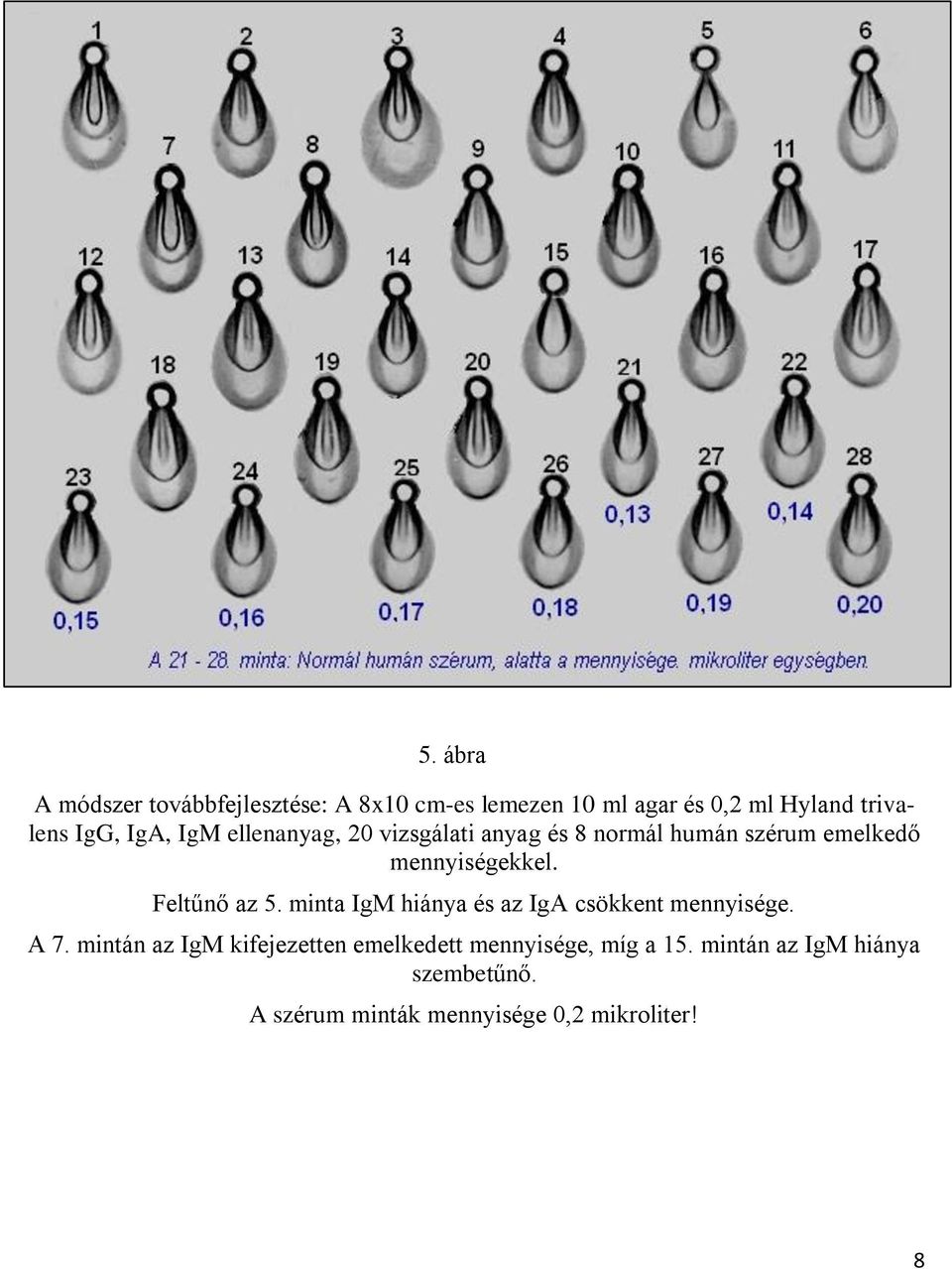 Feltűnő az 5. minta IgM hiánya és az IgA csökkent mennyisége. A 7.