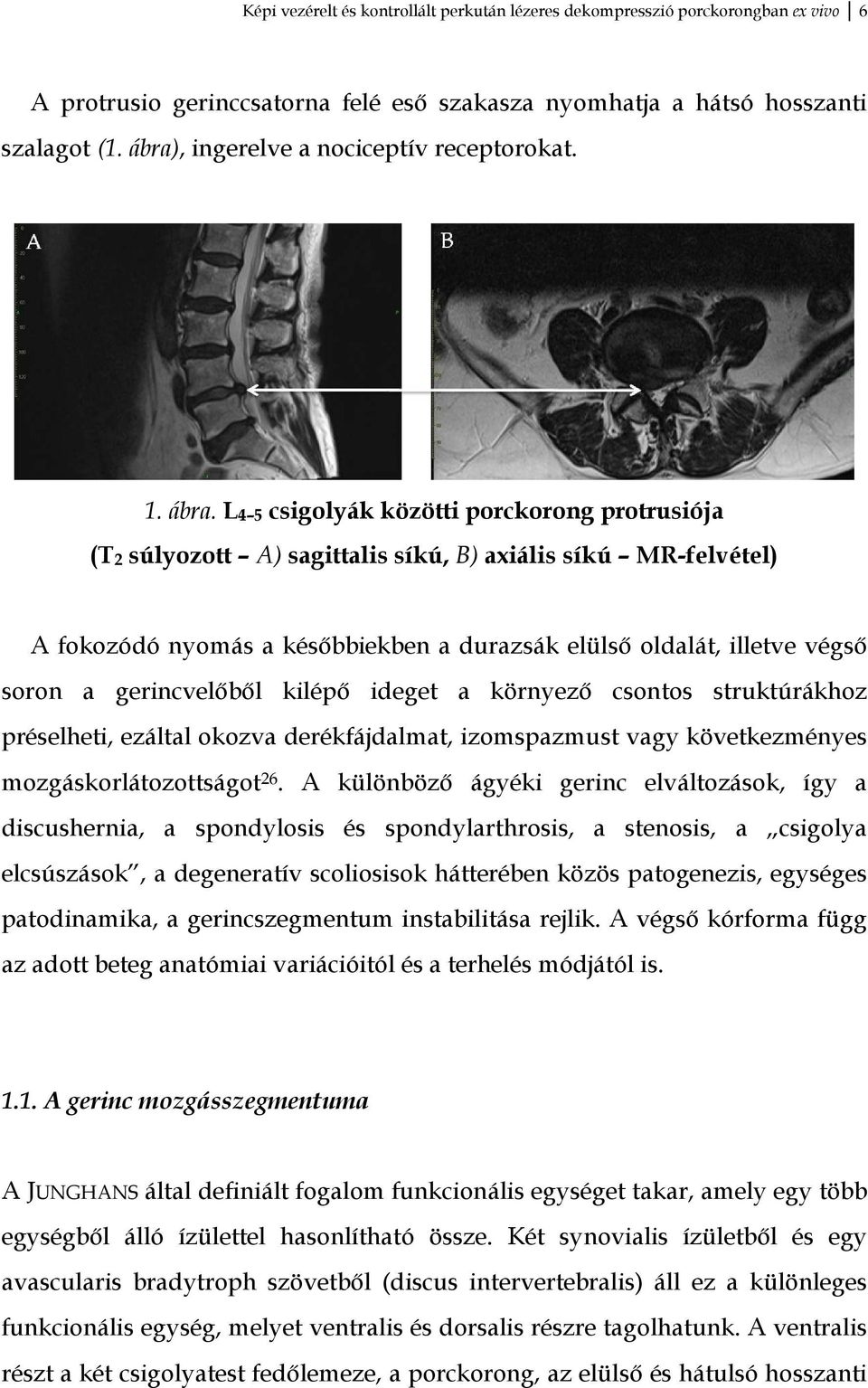 L4 5 csigolyák közötti porckorong protrusiója (T2 súlyozott A) sagittalis síkú, B) axiális síkú MR-felvétel) A fokozódó nyomás a későbbiekben a durazsák elülső oldalát, illetve végső soron a