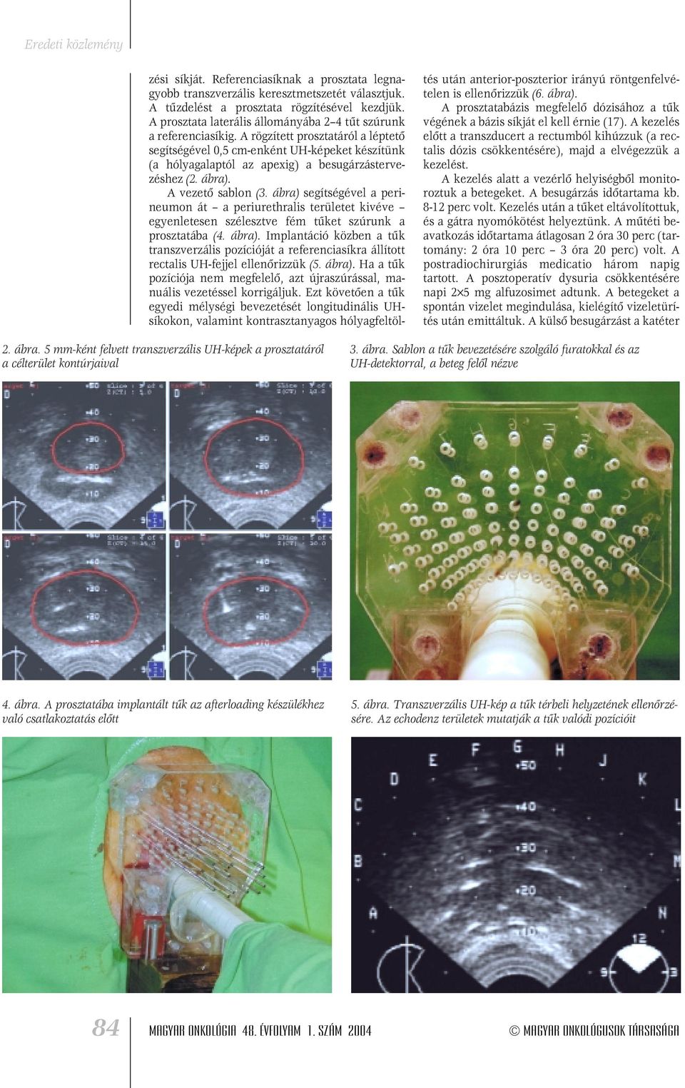 A rögzített prosztatáról a léptetô segítségével 0,5 cm-enként UH-képeket készítünk (a hólyagalaptól az apexig) a besugárzástervezéshez (2. ábra). A vezetô sablon (3.