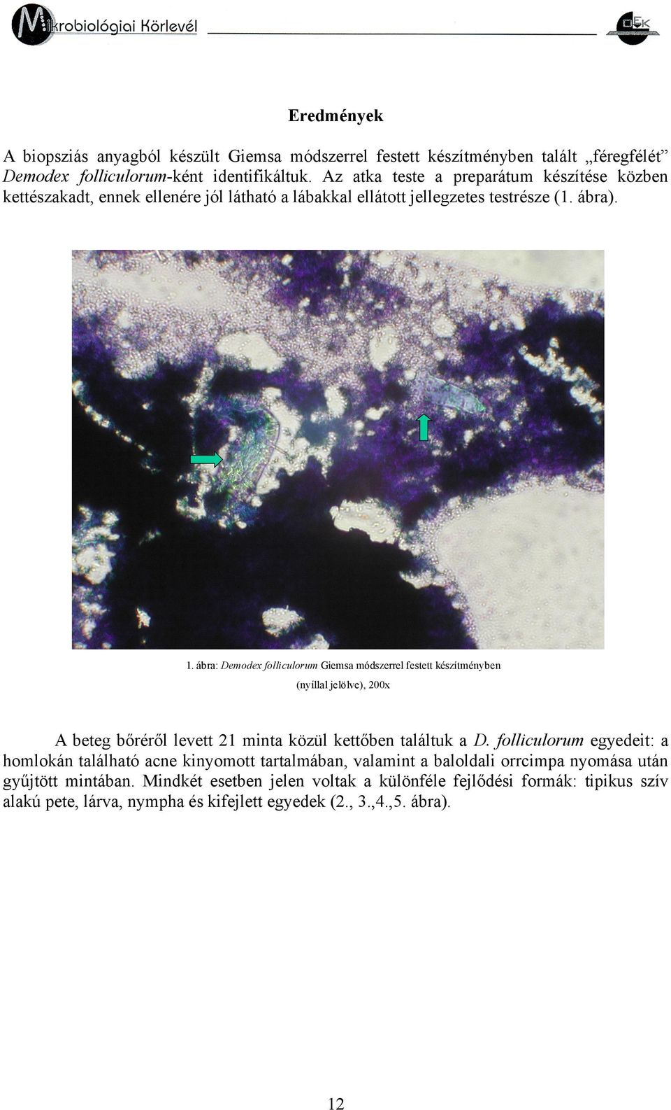 . ábra: Demodex folliculorum Giemsa módszerrel festett készítményben (nyíllal jelölve), 200x A beteg bőréről levett 2 minta közül kettőben találtuk a D.
