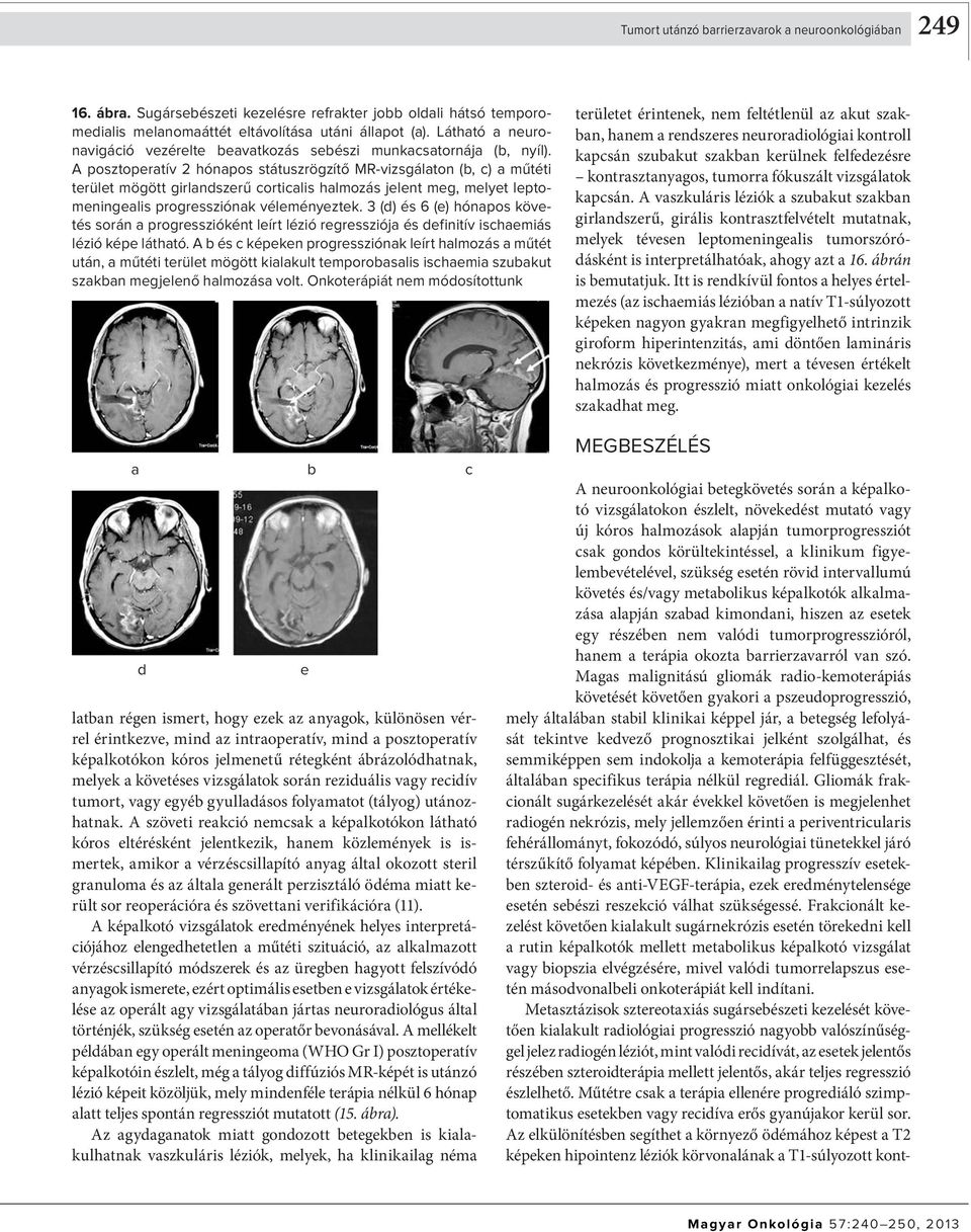 A poszt oprtív 2 hónpos státuszrögzítő MR-vizsgálton (, ) műtéti trült mögött girlnszrű ortilis hlmozás jlnt mg, mlyt lp tomnin glis progrssziónk vélményztk.