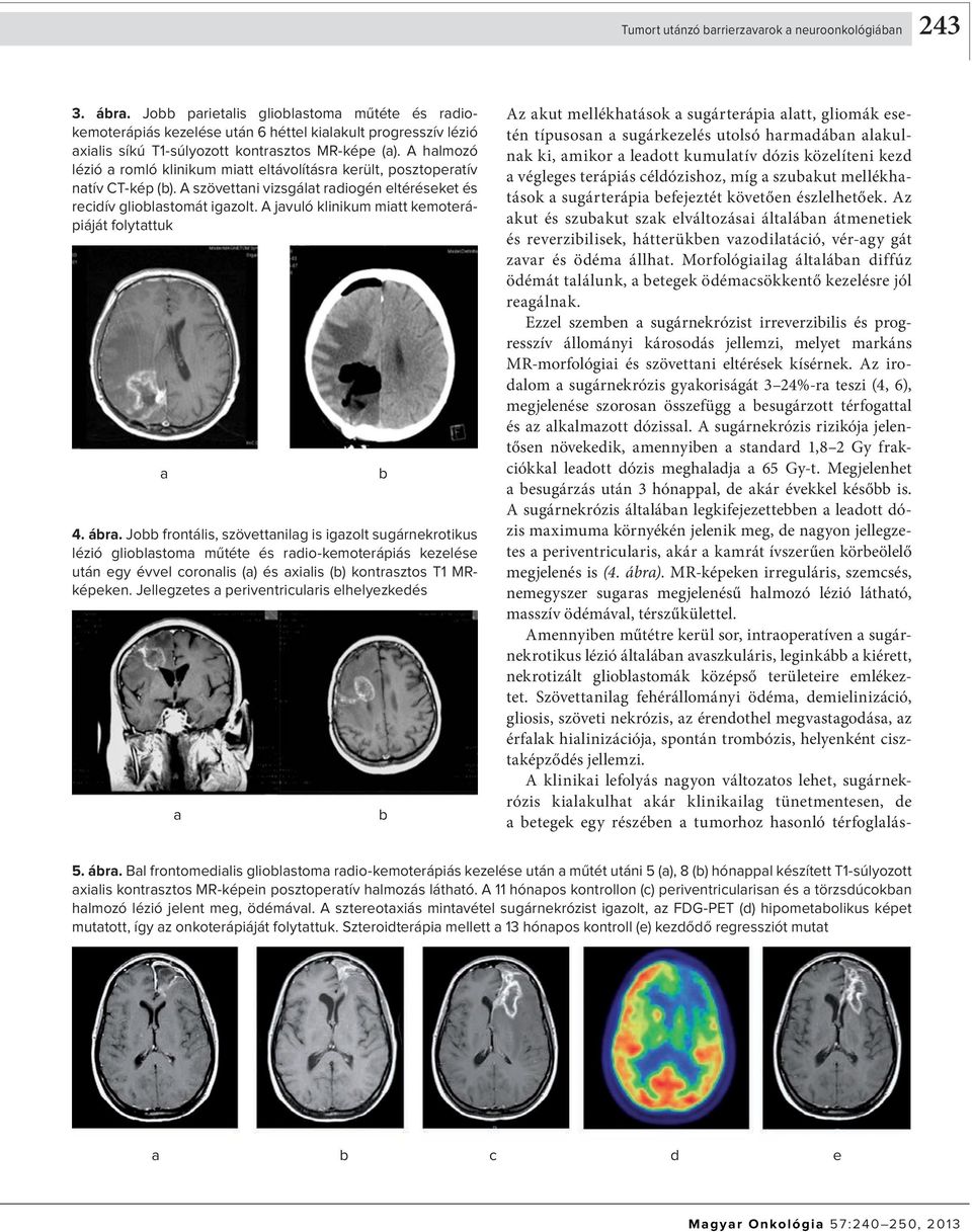 Jo frontális, szövttnilg is igzolt sugárnkrotikus lézió gliolstom műtét és rio-kmotrápiás kzlés után gy évvl oronlis () és xilis () kontrsztos T1 MRképkn.