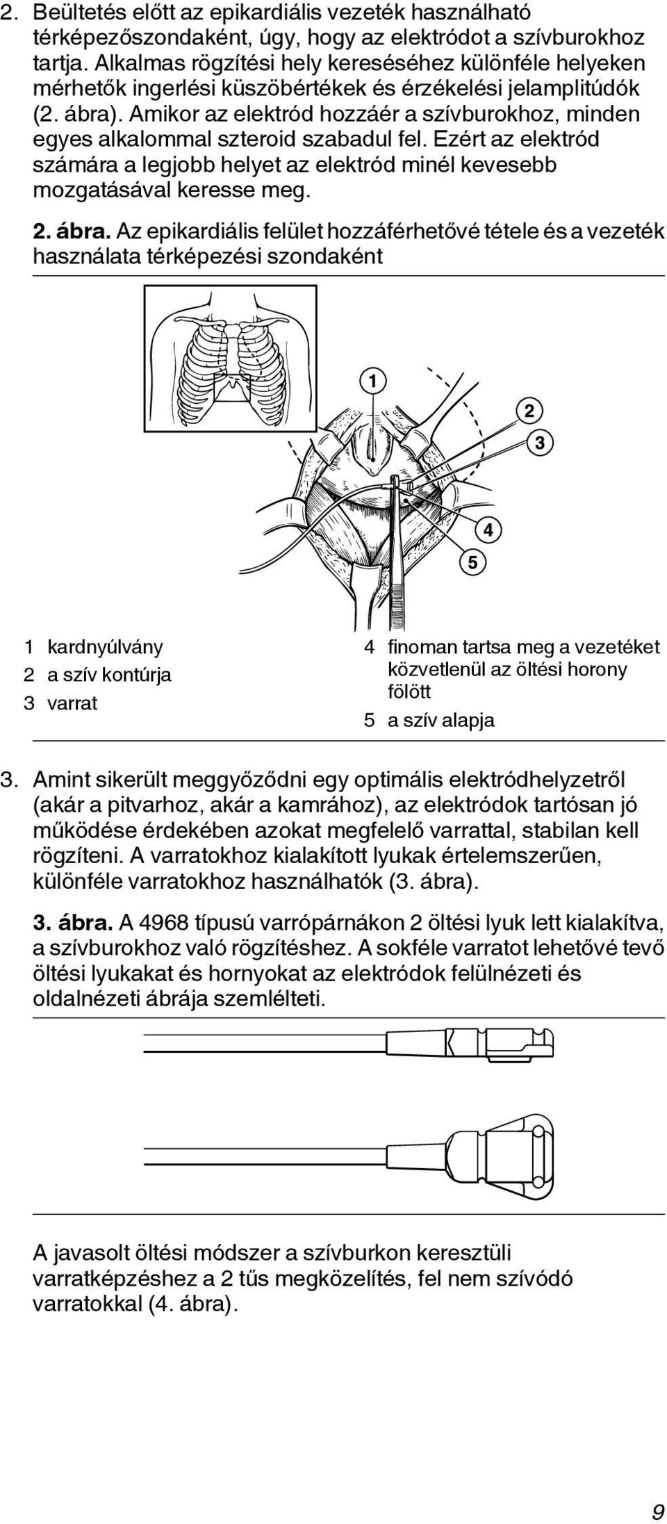 Amikor az elektród hozzáér a szívburokhoz, minden egyes alkalommal szteroid szabadul fel. Ezért az elektród számára a legjobb helyet az elektród minél kevesebb mozgatásával keresse meg. 2. ábra.