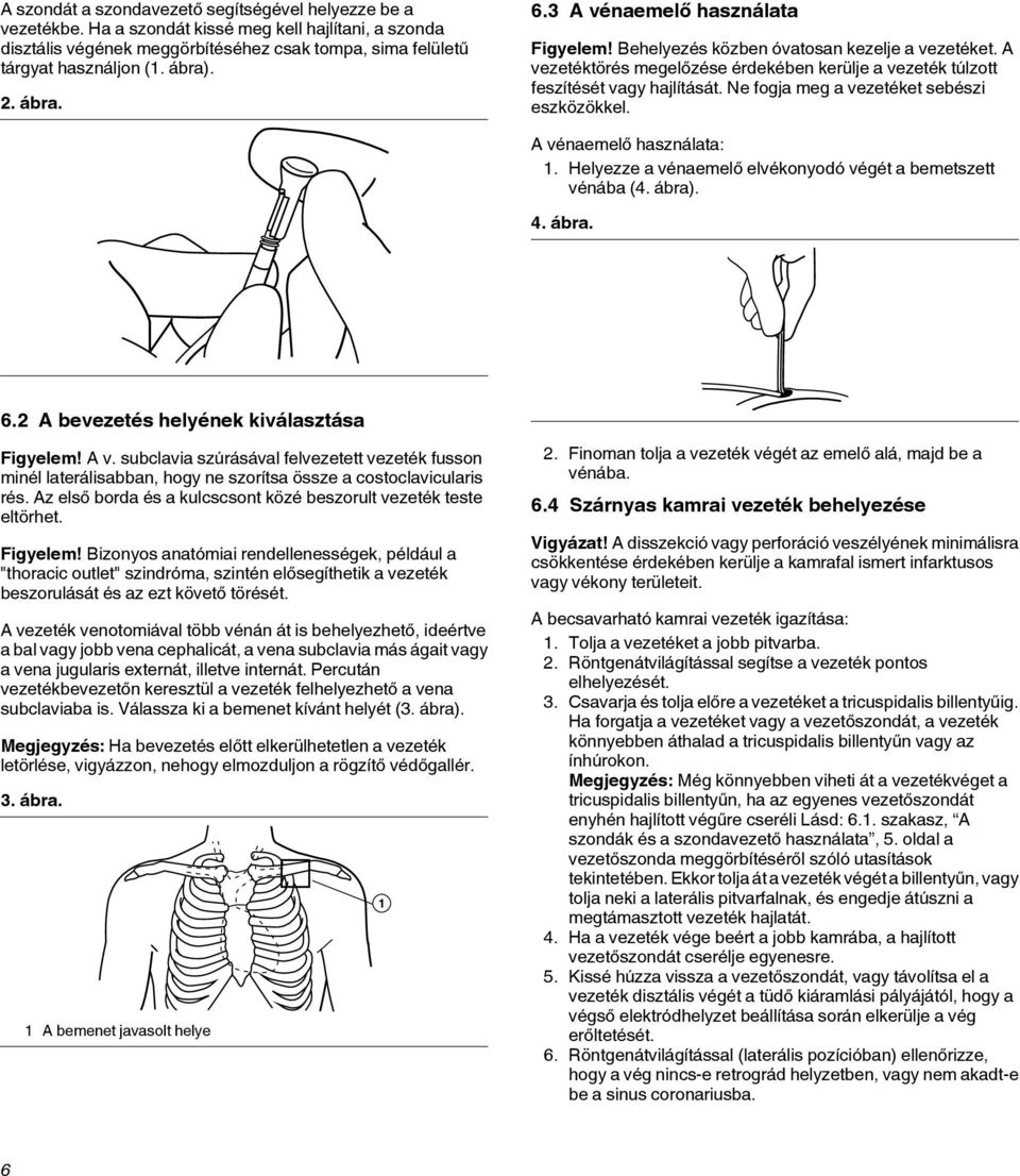 Ne fogja meg a vezetéket sebészi eszközökkel. A vénaemelő használata: 1. Helyezze a vénaemelő elvékonyodó végét a bemetszett vénába (4. ábra). 4. ábra. 6.2 A bevezetés helyének kiválasztása Figyelem!