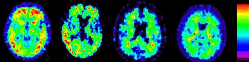 PET: 11 C-PIB ALKALMAZÁSA AZ ALZHEIMER KÓRBAN AD MCI AD MCI