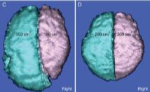 A cortex kialakulása I. Kóros proliferáció vagy apoptózis Germinális mátrix 1. Proliferáció 2. Migráció 3. Organizáció Cortex AJ Barkovich után A.MICROCEPHALIA (MIC) egyéb elváltozásokkal B.