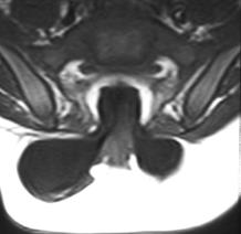 Nyitott dysraphismusok (mindig Chiari-II-vel!) A. Myelomeningocele 98,8%! a plakód kidomborodik B. Myelocele a plakód a bőrrel egy szintben C. Hemimyelomeningocele D. Hemimyelocele A. B. A gerinc fejlődési rendellenességek klinikaineuroradiológiai osztályozása (P.