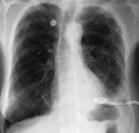 Herndon Malignant Pleural Effusions: Treatment with