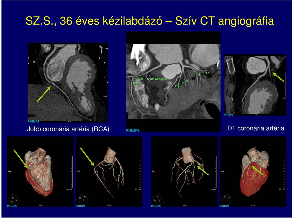 angiográfia Jobb