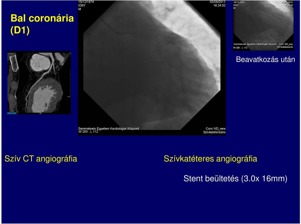 angiográfia Szívkatéteres