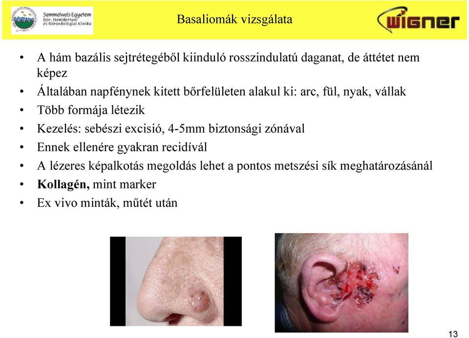 zónával Ennek ellenére gyakran recidívál A lézeres képalkotás megoldás lehet a pontos metszési sík meghatározásánál