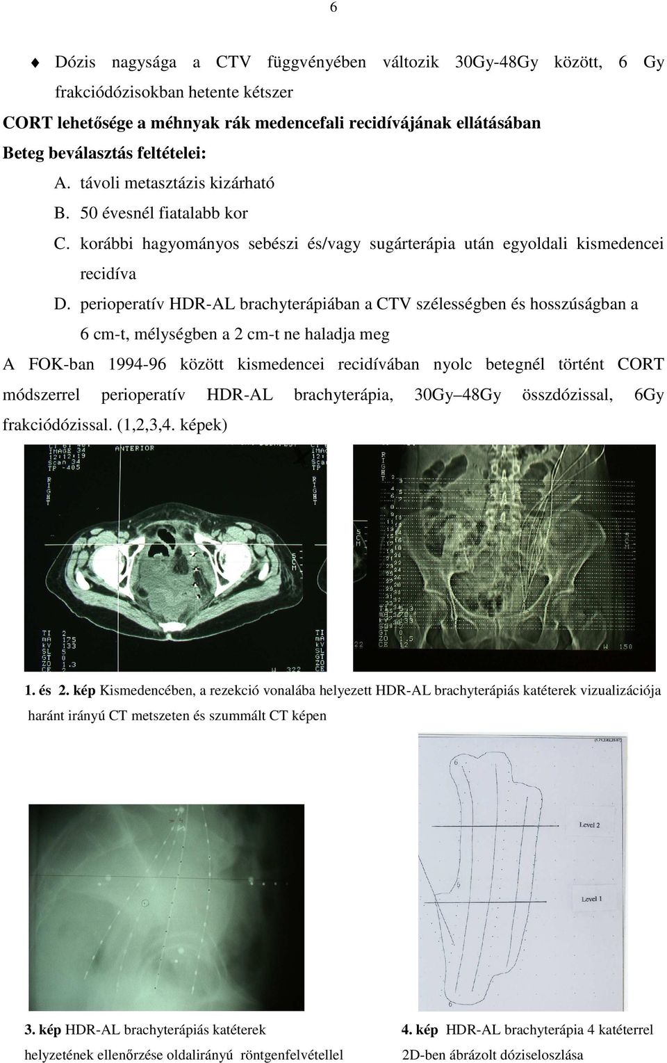 perioperatív HDR-AL brachyterápiában a CTV szélességben és hosszúságban a 6 cm-t, mélységben a 2 cm-t ne haladja meg A FOK-ban 1994-96 között kismedencei recidívában nyolc betegnél történt CORT