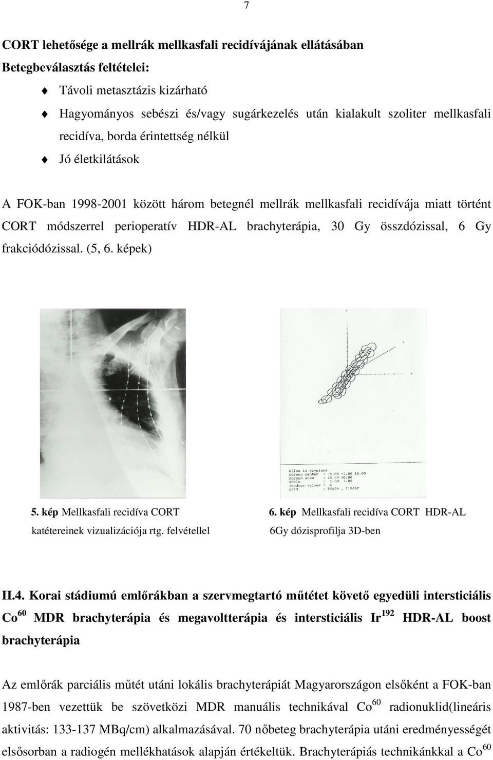 brachyterápia, 30 Gy összdózissal, 6 Gy frakciódózissal. (5, 6. képek) 5. kép Mellkasfali recidíva CORT 6. kép Mellkasfali recidíva CORT HDR-AL katétereinek vizualizációja rtg.