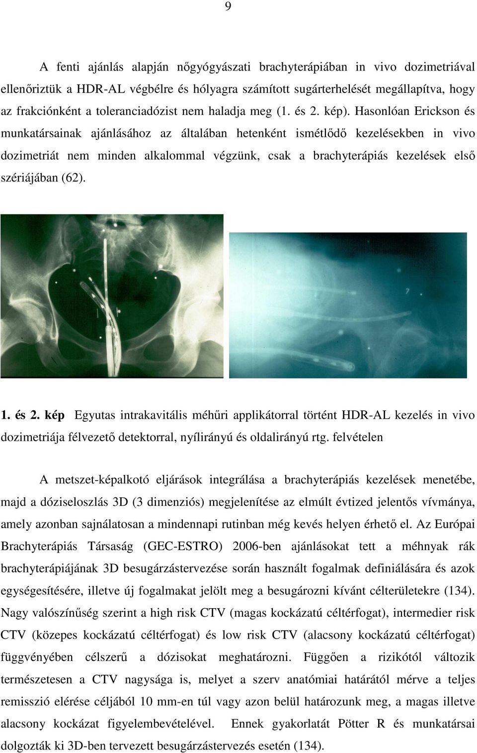 Hasonlóan Erickson és munkatársainak ajánlásához az általában hetenként ismétlıdı kezelésekben in vivo dozimetriát nem minden alkalommal végzünk, csak a brachyterápiás kezelések elsı szériájában (62).