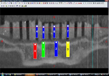 Röntgen sablon készítése Sablon alkalmazása Pótlás modellezése Implantáció a pótlásnak