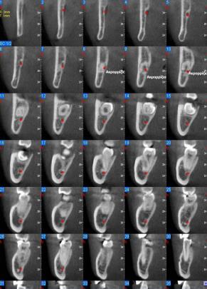 CBCT CT és CBCT összehasonlítása CT Leképezendő térfogat (FOV) Kemény és lágyszövet kontraszt Nem optimális Kiváló Hounsfield-egység mérése Pontatlan Pontos FOV kiterjeszthetősége Limitált Tetszés