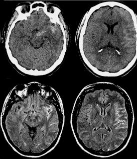 Akut vérzéses stroke: CT Akut stroke: CT és MR nct ap at2 Vérzés?