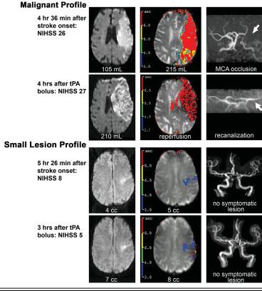 Akut ischaemia: Gátolt diffúzió a trace/adc képeken Akut agytörzsi ischaemia Akut hemodinamikai ischaemiás laesiók a bal frontoparietalis régióban, valószínűleg bal ACI stenosis miatt, krónikus