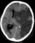 Malignus media infarctus ischaemiás laesio az ACM több mint 50%-át érinti következményes oedema, intracranialis nyomásfokozódás beékelődés veszélye maximális konzervatív terápia mellett is akár