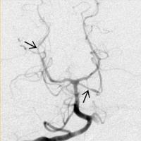 Immun vasculitis - SLE Primer központi idegrendszeri angiitis Tipikus subcorticalis FÁ elváltozások, FÁ jelfokozódás és infarctusok SLE-s betegeknél Osborn AG: Diagnostic Imaging Brain.