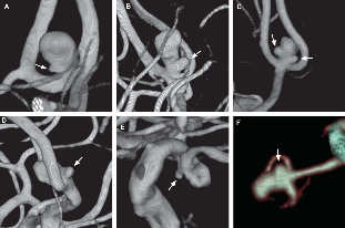 Radiológiai módszerek MR - CT Intracranialis aneurysma multicentrikus retrospektív vizsgálat: olyan családok, ahol legalább 4 családtag érintett volt 16 ikerpár közül 11 MZ-ből 8 konkordáns volt az