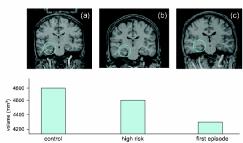 A szkizofrénia etiopatogenezisének modellje Gének Pre- és perinatalis komplikációk Szinaptikus remodelling Szociális környezeti tényezők, drogok Neuronális rendszerek sérülékenysége Praefrontalis