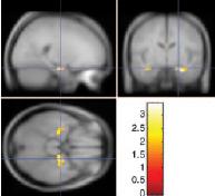 Szkizofrénia és s a velocardiofacialis szindróma (22q11 mikrodeláci ciója) A craniofacialis régióban az organogenezis rendellenességei Agyi strukturális anomáliák Neuropszichológiai zavarok