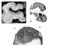 Normál Periventricularis hetereotopiák Polymicrogyria Lamináris heterotopiák