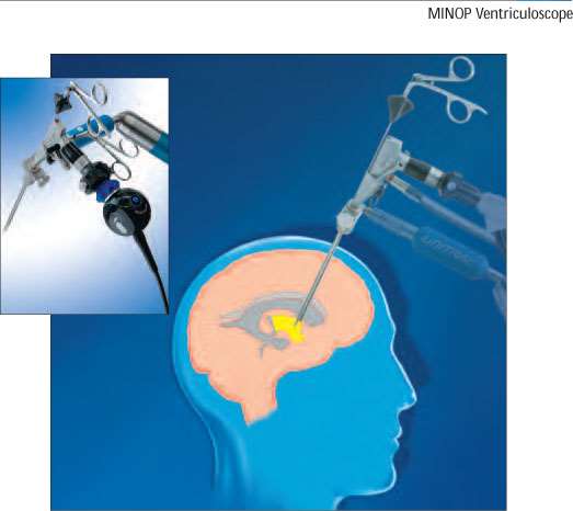 MINOP Erprobung und Bewertung von mikrosystemtechnischen Komponenten zum Einsatz in der minimalinvasiven Neurochirurgie Bundesministerium für Bildung und Technik projektek: MINOP 1