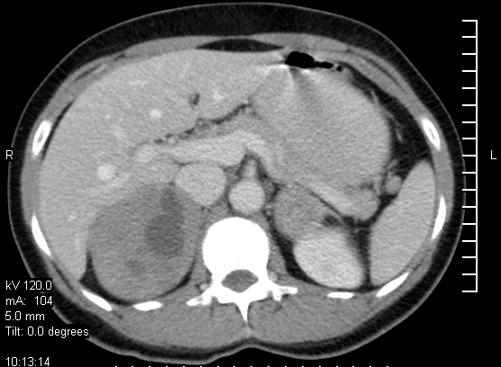 Kétoldali phaeochromocytoma CT és