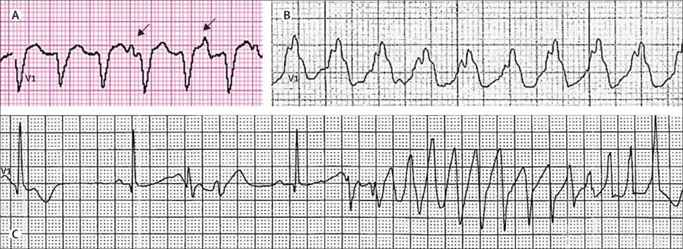 Monomorph BTSZB-os Monomorph JTSZB-os torsade tachycardia nyilak