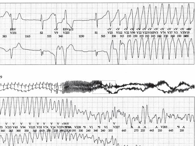 Long QT R on T, tachycardiát indukáló