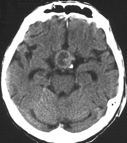 Primer tumorok Hypophysis tumorok Mikroadenoma: 1cm-nél kisebb, hypodenz, nem halmoz