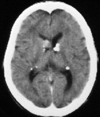 Primer tumorok Astrocytoma - fokális vagy diffúz, - hypodenz, - Ca++ 15-20%, -