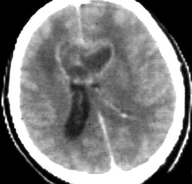 Primer tumorok Glioblastoma - vaskos gyűrű, ált.