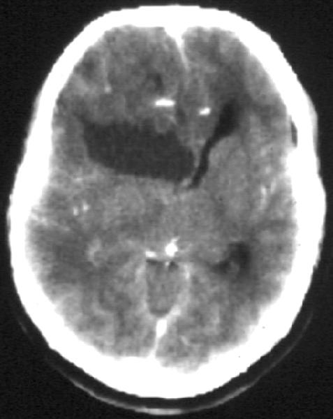 Primer tumorok Oligodendroglioma - CT: hypo-isodenz, nem halmoz 95%-ban meszes gyakori a cystás deg.