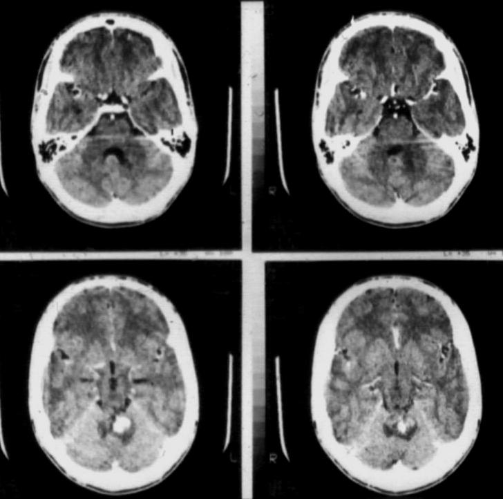 Primer tumorok Plexuspapilloma - Gyerek: trigonum, - Felnőtt: IV.