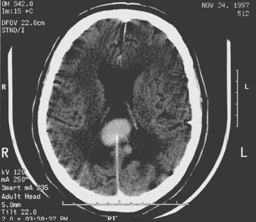 PRIMER TUMOROK Lymphoma Non-Hodgkin lymphoma, ált.