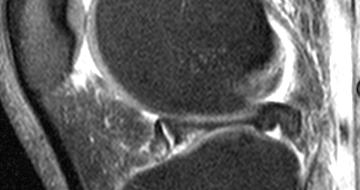 Lateralis meniscus