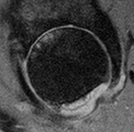 Coxarthrosis: labrum