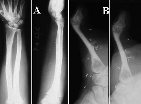 6. ábra Műtét utáni záró felvétel 5. ábra A neuro tendo osceocutan lebeny vétele a donorterületről. Intraoperatív felvétel (A) Röntgenkép (B) 8.