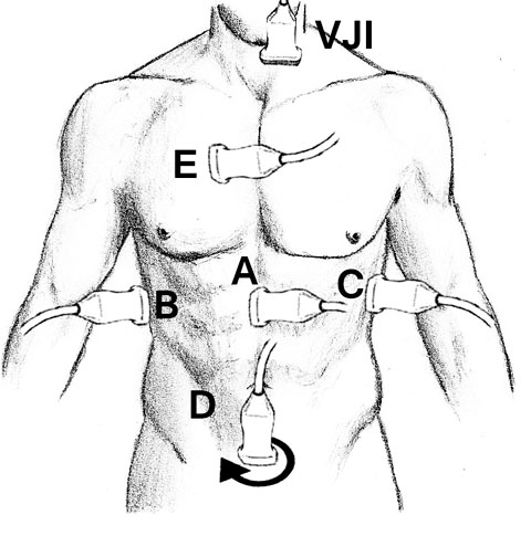 A második lépés: a keringő vérvolument ( tank ) érintő kóros állapotok vizsgálata (6 8). Vena cava inferior sniffteszt A Magyar Radiológia 2013. évi 2.