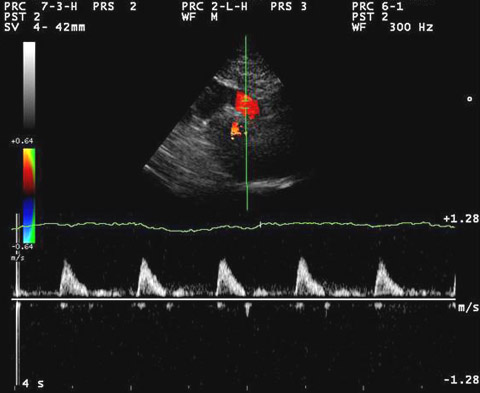 A marker tekintsen a beteg jobb oldala felé! Pontos ábrázolásához fordítsuk a transzducert az aortaív síkjára.