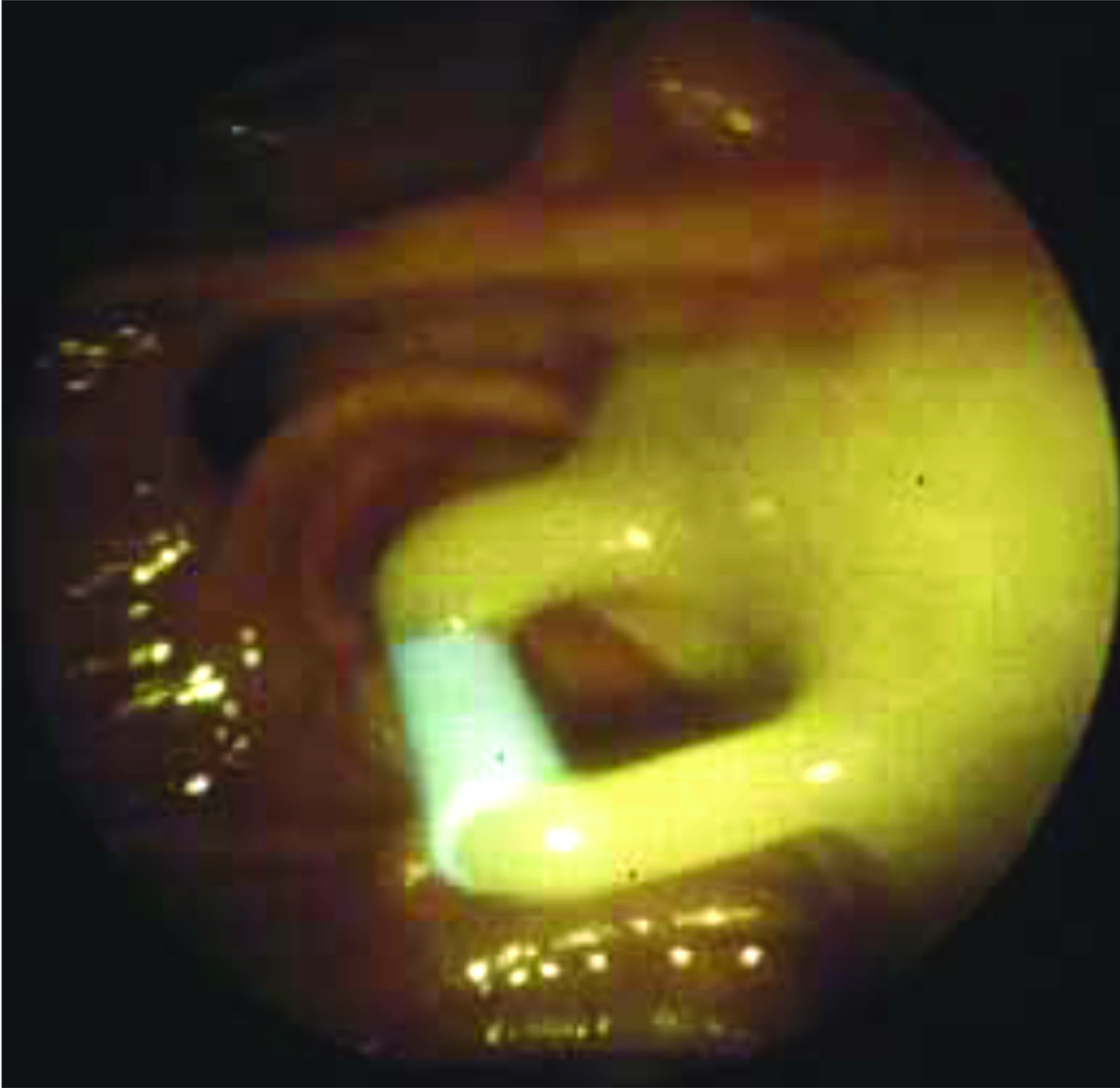 3. ábra Akut cholangitis súlyosságon alapuló kezelése 2. ábra Malignus epeúti szűkület által okozott súlyos gennyes cholangitis stentelés után eredménye alapján kerül sor az ERCP-re.