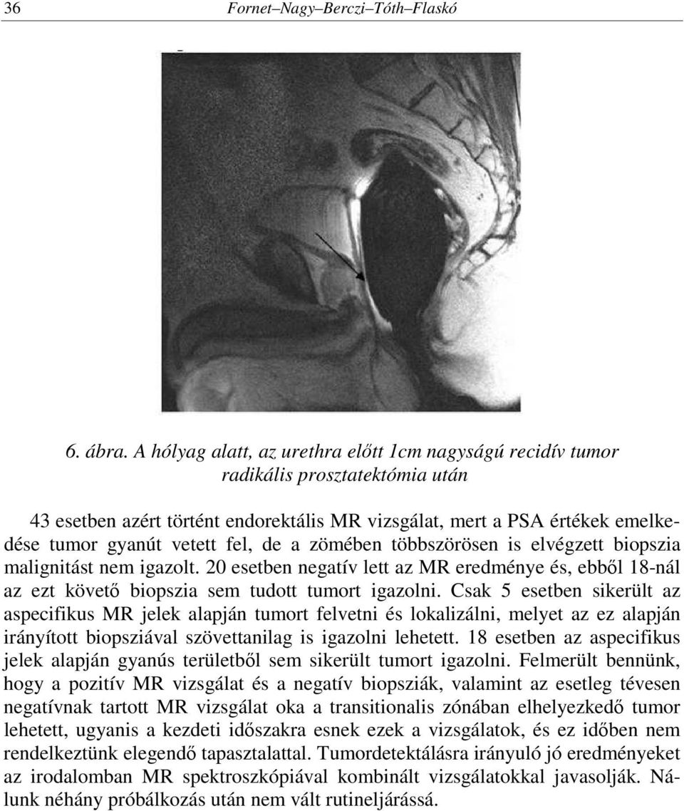 de a zömében többszörösen is elvégzett biopszia malignitást nem igazolt. 20 esetben negatív lett az MR eredménye és, ebből 18-nál az ezt követő biopszia sem tudott tumort igazolni.