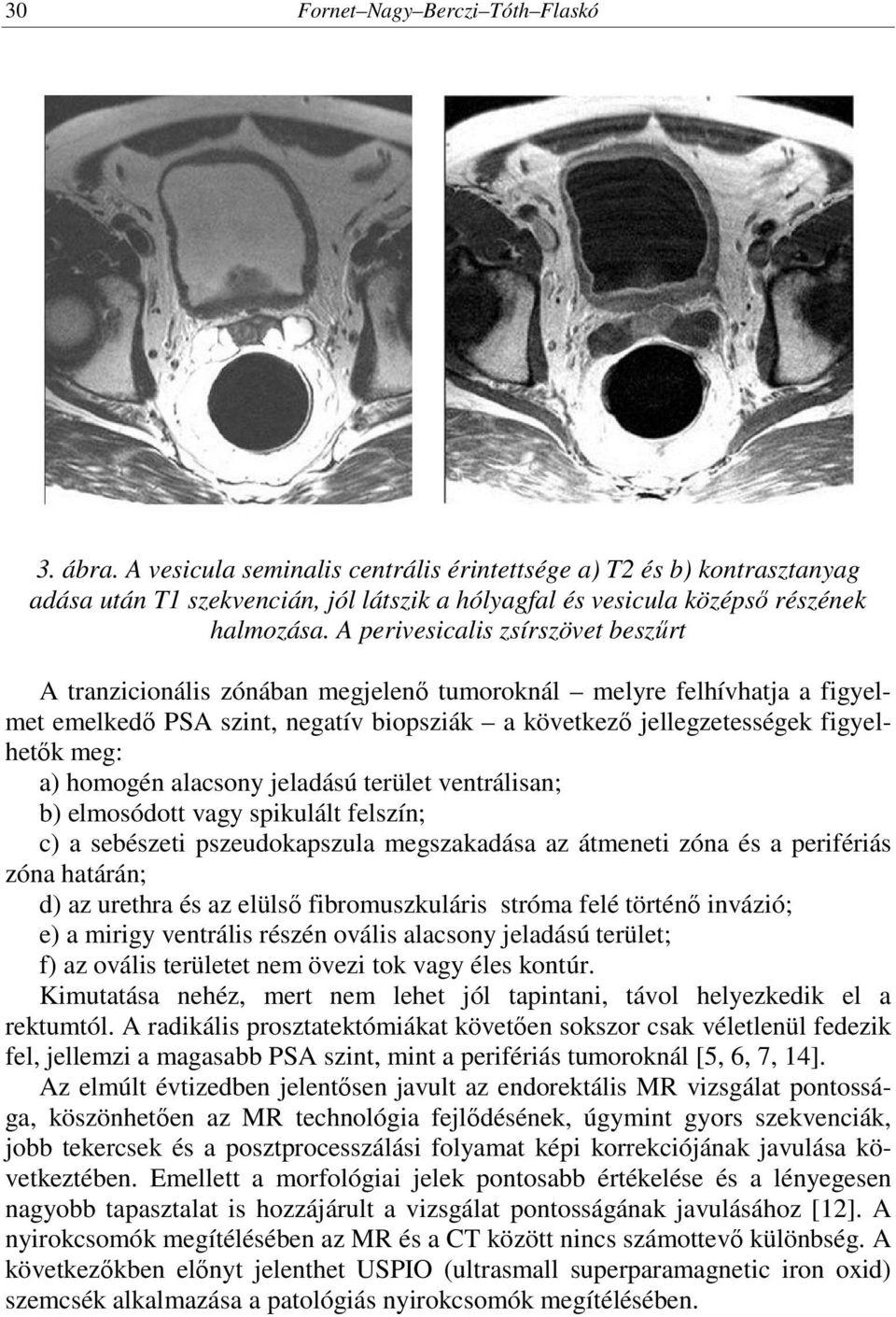 A perivesicalis zsírszövet beszűrt A tranzicionális zónában megjelenő tumoroknál melyre felhívhatja a figyelmet emelkedő PSA szint, negatív biopsziák a következő jellegzetességek figyelhetők meg: a)