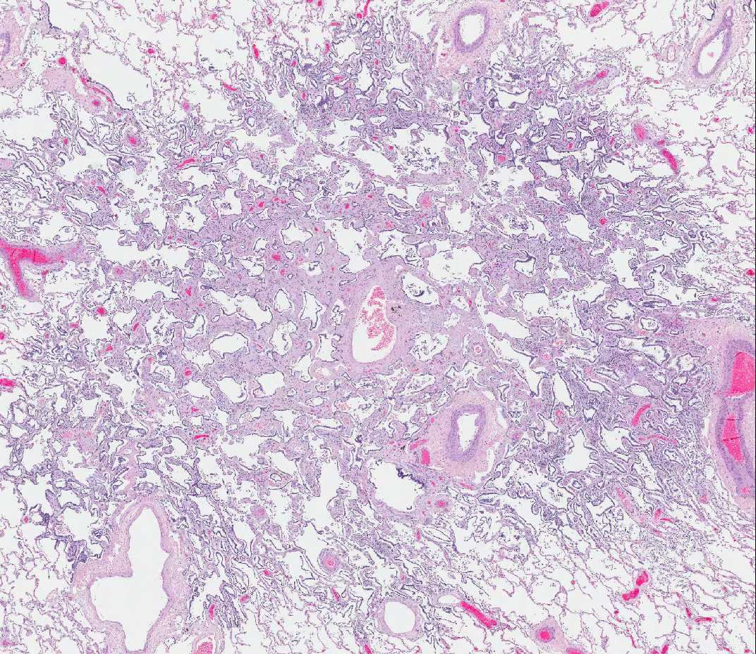 Adenocarcinoma in situ (AIS) nem mucinózus és/vagy mucinózus Korábban: Bronchioloalveoláris carcinoma Az alveoláris szeptumok