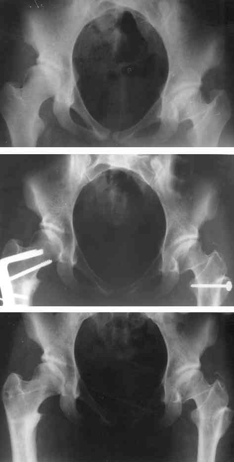 ANYAG ÉS MÓDSZER Tíz év alatt (1983 93) 20 betegen végeztünk femur rövidítéses mûtétet subtrochantericus osteotomia segítségével.