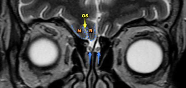 olfactorius és a sulcus