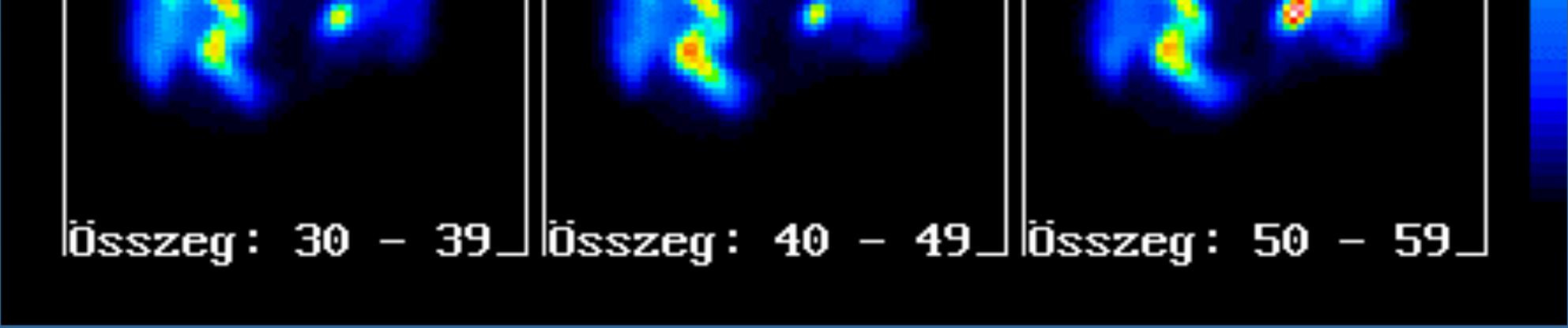 Az epetermelés-lefolyás izotópdiagnosztikája Durva göbös májzsugorodás (6 irányú felvétel) ( Ld:statikus vizsgálatok!) Az epetermelés adatai: percenként 0,4 ml, de naponta 600!